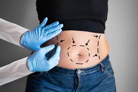 Say Goodbye to Stubborn Fat: Why Liposuction in Dubai Is Gaining Global Attention