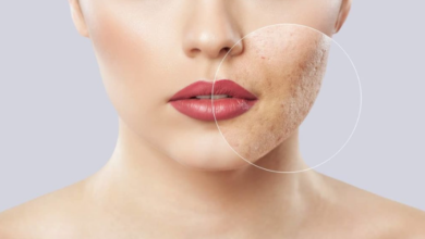 Effective Solutions for Acne Scars and Sunken Cheeks in Miami