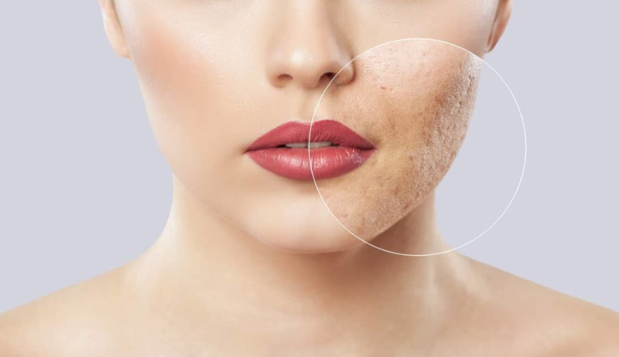 Effective Solutions for Acne Scars and Sunken Cheeks in Miami